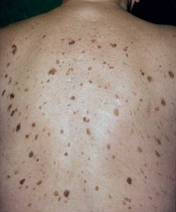 Keratoza | Dijagnoze | Ordinacija Beoderma