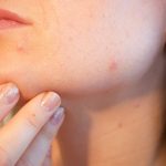 lečenje akni-dermatologija-dermantovenerologija-dermatolog